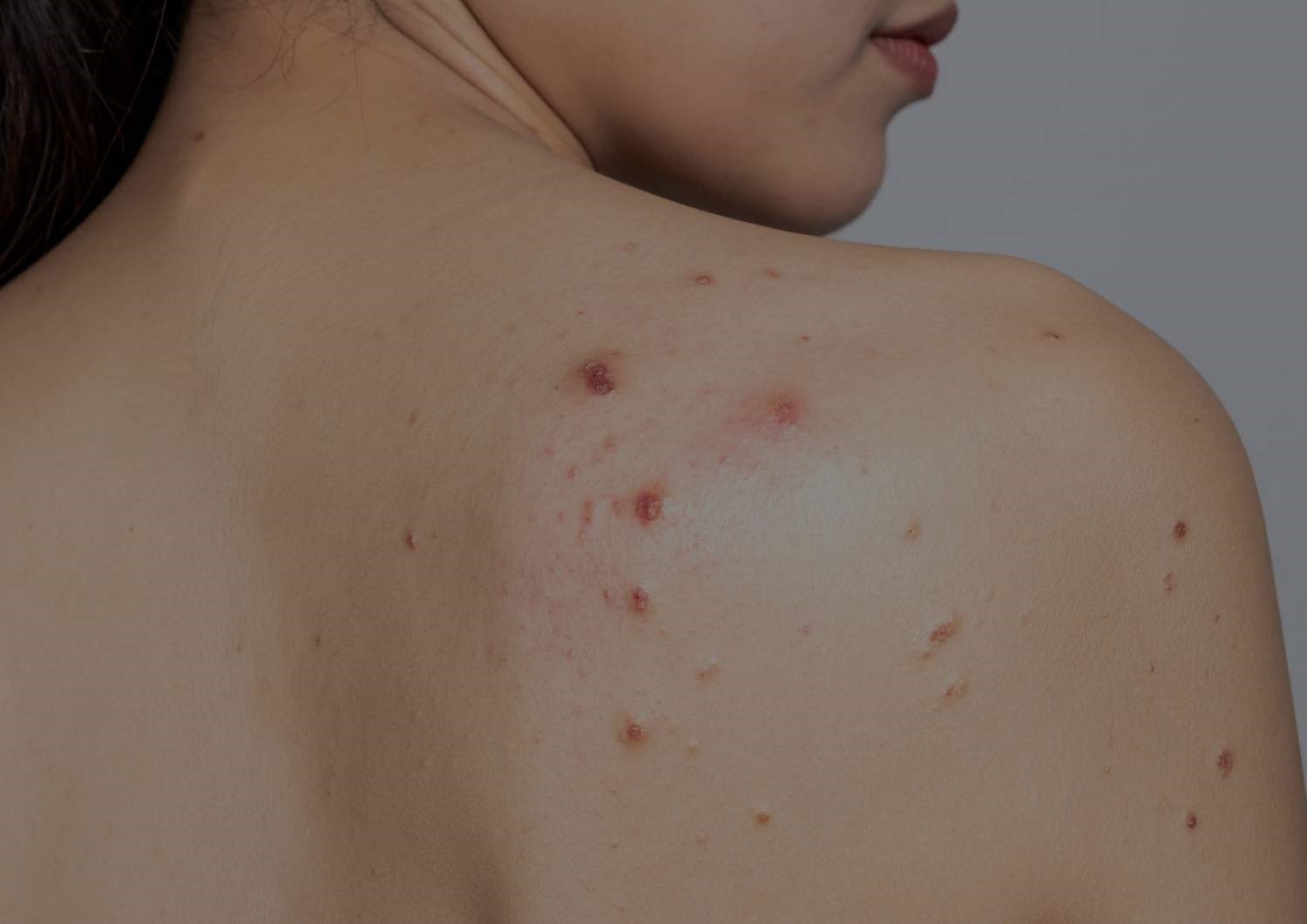 Basal Cell Carcinoma Basal Cell Carcinoma